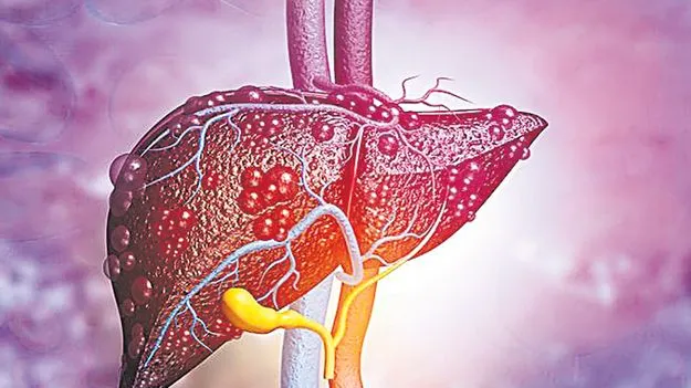 ఫ్యాటీ లివర్‌తో పరేషాన్‌