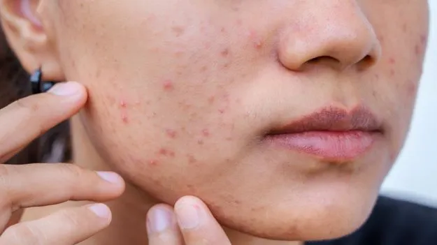 చర్మంపై మొటిమలు రావడానికి కారణం ఏమిటి..