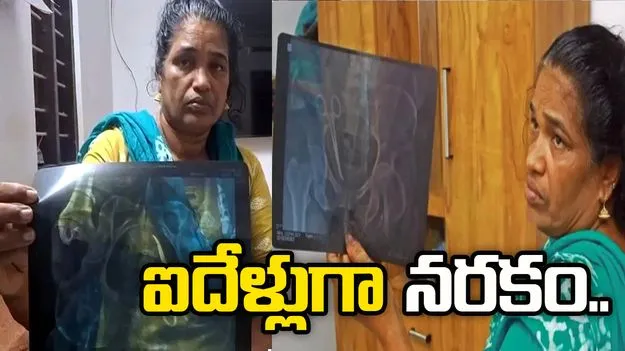 దారుణం.. మహిళ కడుపులో కత్తెర మరిచారు.. ఐదేళ్ల తర్వాత..