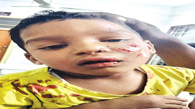 కుక్కల దాడి: బాలుడికి తీవ్ర గాయాలు