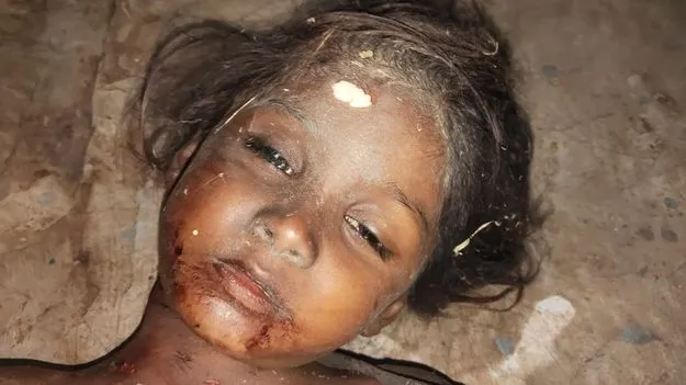 వీధి కుక్కల దాడిలో చిన్నారి మృతి