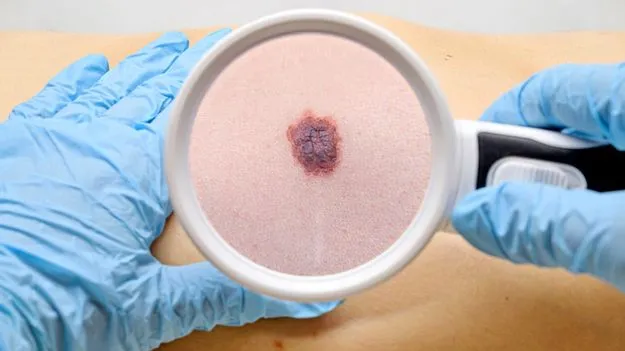 పుట్టుమచ్చల్లో మార్పులు చర్మక్యాన్సర్‌కు సంకేతాలు