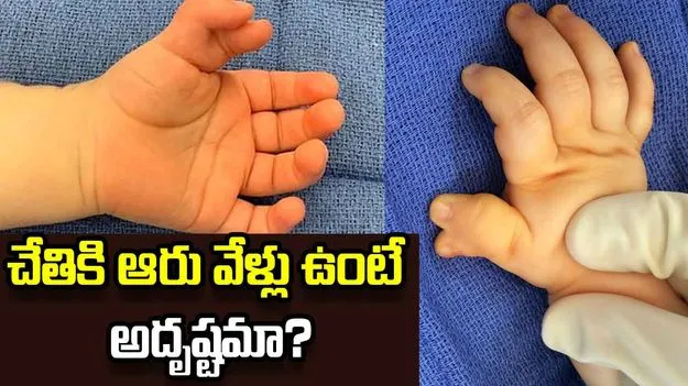 చేతికి ఆరు వేళ్లు ఉంటే అదృష్టమా?
