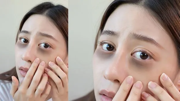 నల్లని వలయాలు ఇలా మాయం