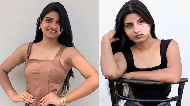 విటిలిగో విన్నర్‌