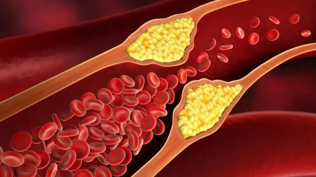 కొలెస్ట్రాల్‌ కలవరపెడుతోంది!