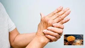 ఈ చిన్న చిట్కాతో ఆర్థరైటిస్‌కు చెక్..