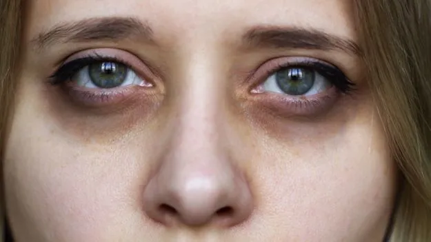 కళ్ల కింద డార్క్ సర్కిల్స్ తగ్గాలంటే క్రీములు మాత్రమే సరిపోవు..  ఇవి కూడా పాటించాలి