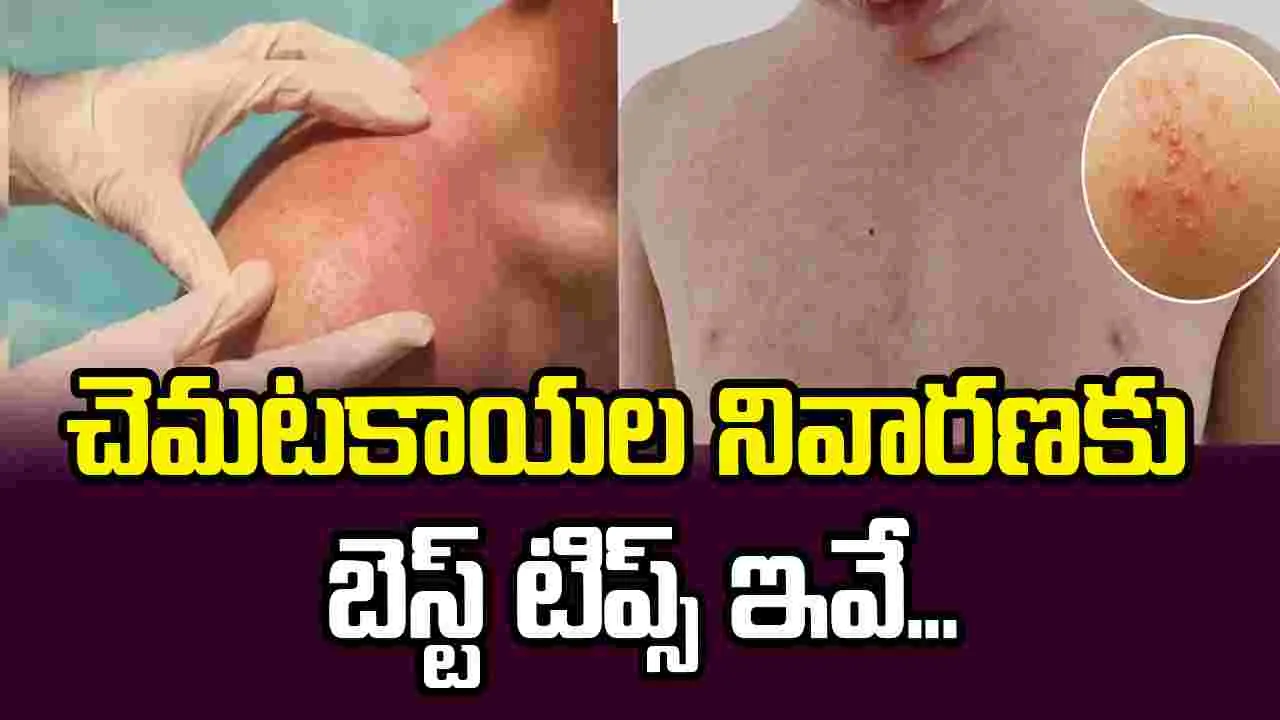 వేసవిలో చెమటకాయలు వేధిస్తున్నాయా? ఈ ఇంటి చిట్కాలతో చెక్ పెట్టండి!