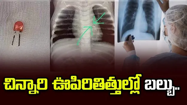 చిన్నారి ఊపిరితిత్తుల్లో ఇరుక్కున్న బల్బు.. తొలగించిన ఆర్మీ డాక్టర్లు..