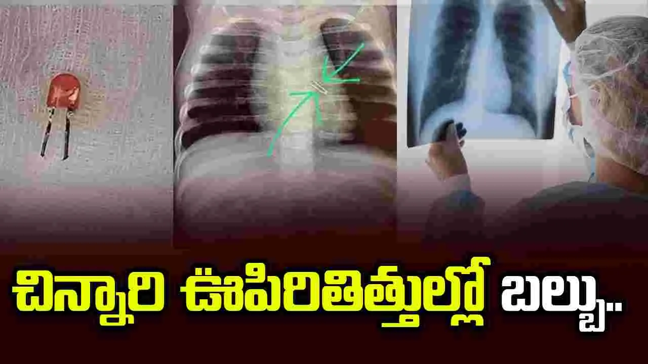 చిన్నారి ఊపిరితిత్తుల్లో ఇరుక్కున్న బల్బు.. తొలగించిన ఆర్మీ డాక్టర్లు..