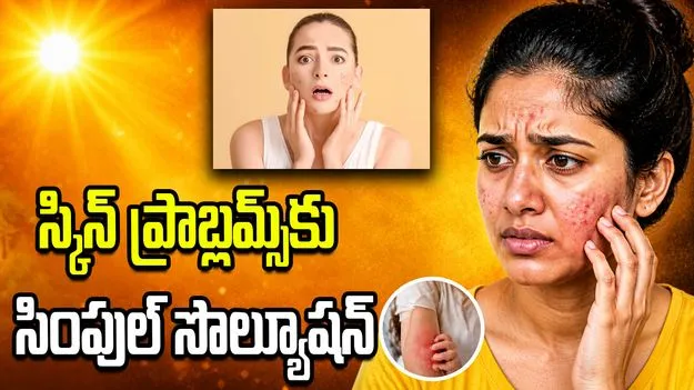 వేసవిలో మొటిమలు, దురదతో ఇబ్బంది పడుతున్నారా? ఈ టిప్స్ మీకోసం