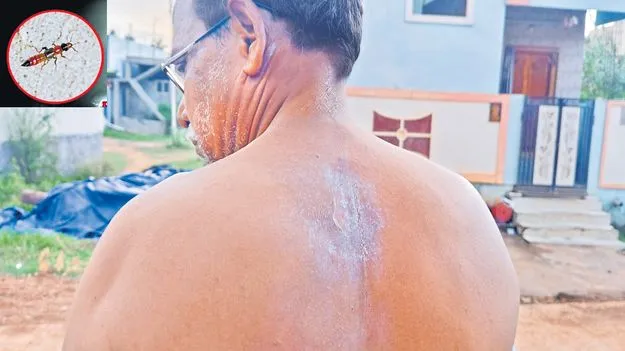 మంట పుట్టిస్తున్న అగ్గి పురుగు 