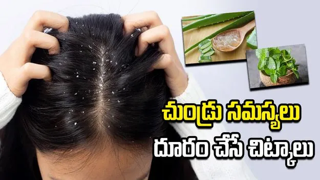 వేసవిలో చుండ్రు, మాడు దురద సమస్యలా?  ఈ చిట్కాలతో చెక్ పెట్టండి