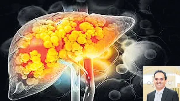 యువతలో పెరుగుతున్న ఫ్యాటీ లివర్‌ ముప్పు 