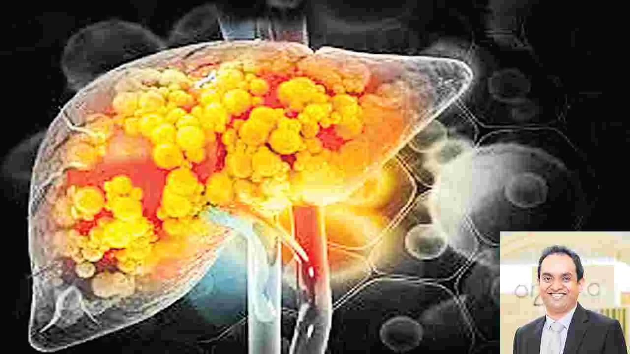 యువతలో పెరుగుతున్న ఫ్యాటీ లివర్‌ ముప్పు