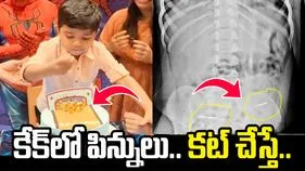 షాక్ ఇచ్చిన బర్త్‌డే కేక్.. బాలుడి కడుపును స్కానింగ్ చేసి చూడగా..