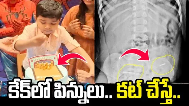 షాక్ ఇచ్చిన బర్త్‌డే కేక్.. బాలుడి కడుపును స్కానింగ్ చేసి చూడగా..
