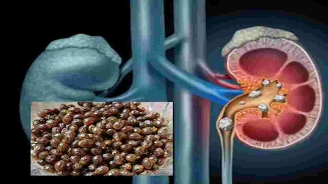 Kidney stones in children