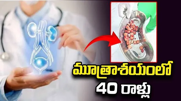 మూత్రాశయంలో 40 రాళ్లు