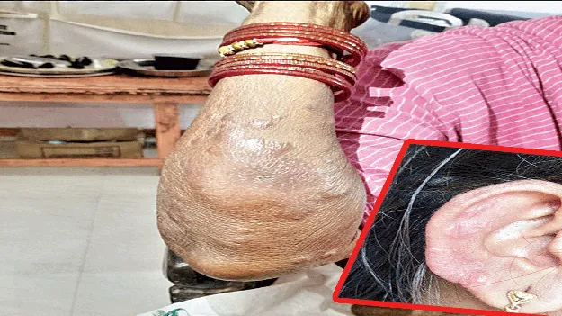 లెప్రసీ పంజా!